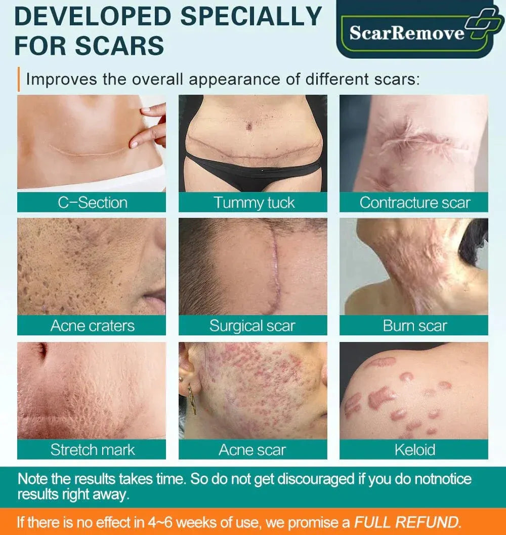 Advanced Scar Spray For All Types of Scars - For example Acne Scars, Surgical Scars and Stretch Marks ⚡️⚡️⚡️